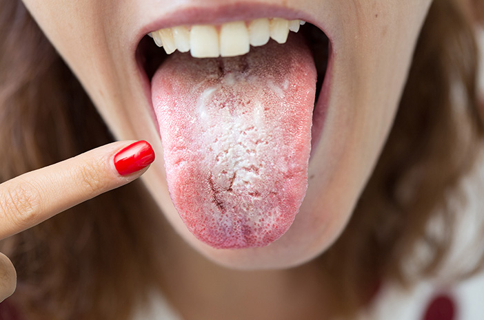 5 Warna Lidah Ini Membantu Anda Mengenali Penyakit yang Anda Alami