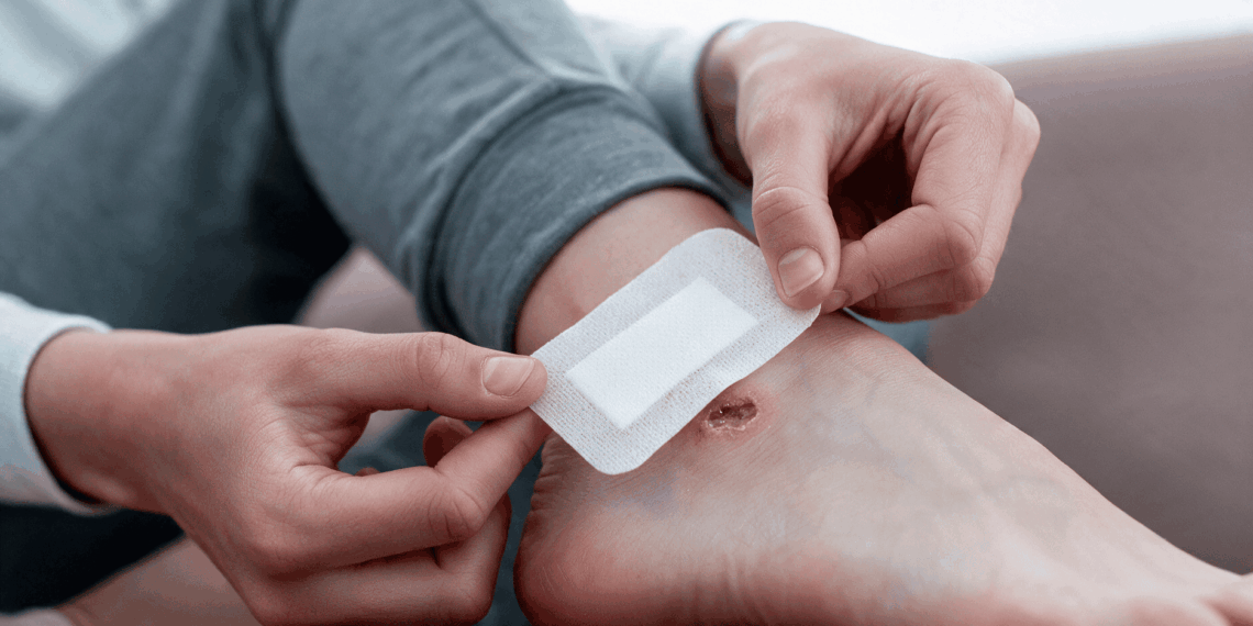 Perawatan Luka Kaki pada Pasien Diabetes untuk Mencegah Terjadinya Komplikasi